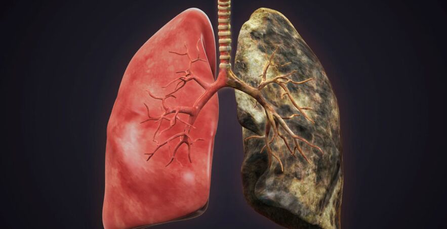 smoker's lungs and quit smoking lungs